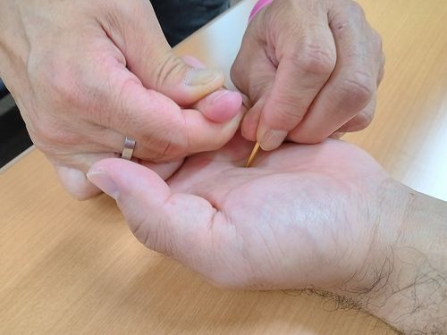 中手指節関節機能障害の反応点